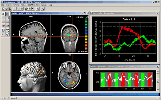 脳画像処理ソフト ブレインボイジャー 写真